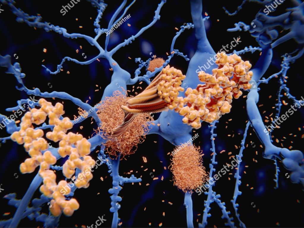 stock-photo-alzheimer-s-disease-the-amyloid-beta-peptide-accumulates-to-amyloid-fibrils-that-build-up-dense-1157052994